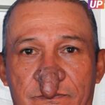 ST, The Remarkable Transformation of Conrado’s Nose